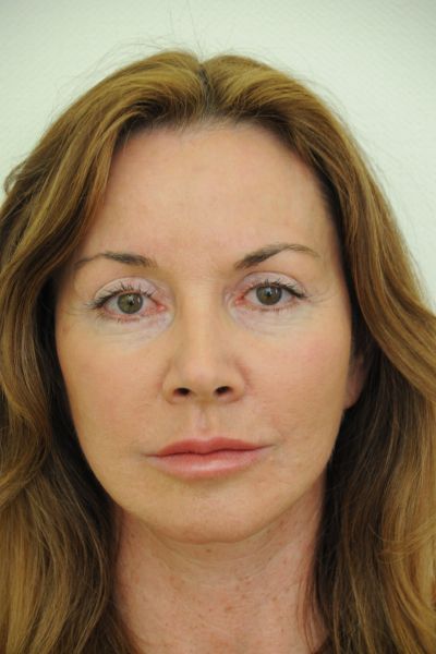 facelift-patient-01 After - 2