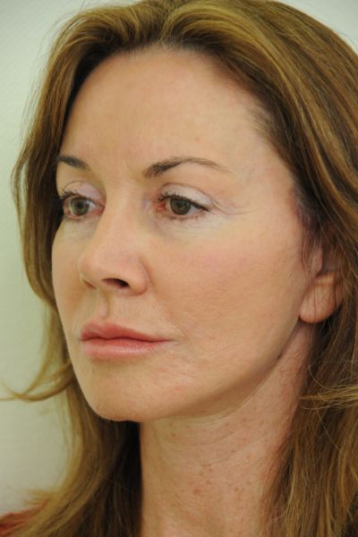 facelift-patient-01 After - 3