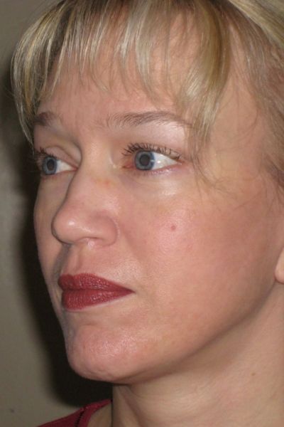 facelift-patient-05 After