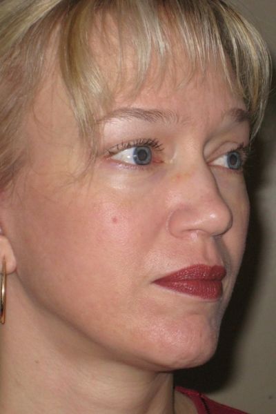 facelift-patient-05 After - 2