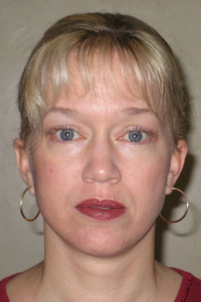 facelift-patient-05 After - 3