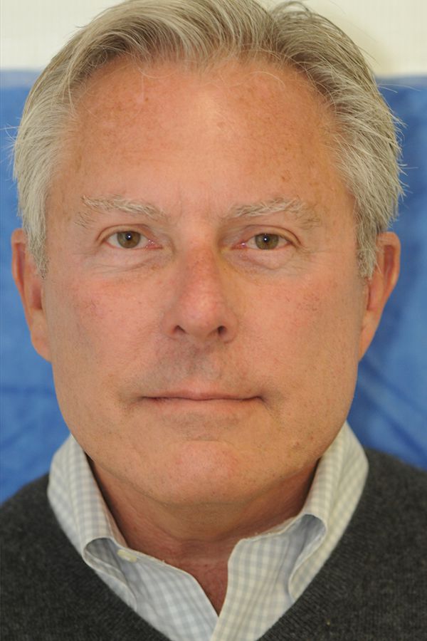 male-facelift-patient-02 After - 4