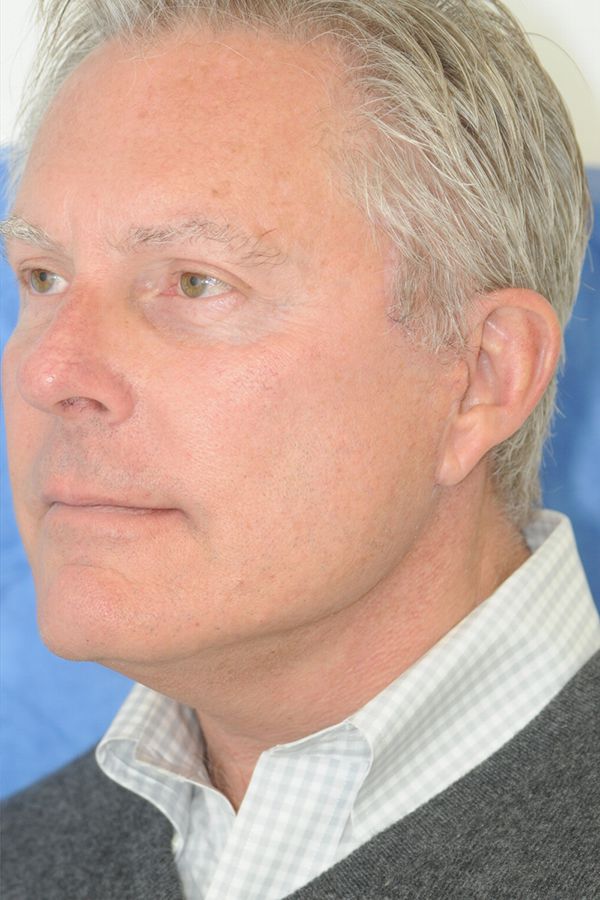 male-facelift-patient-02 After - 5