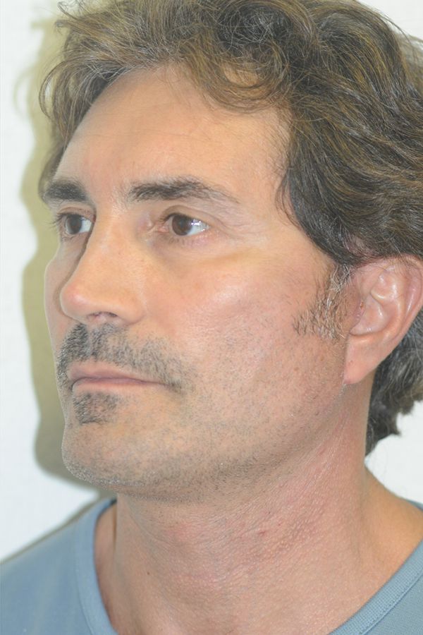 male-facelift-patient-01 After