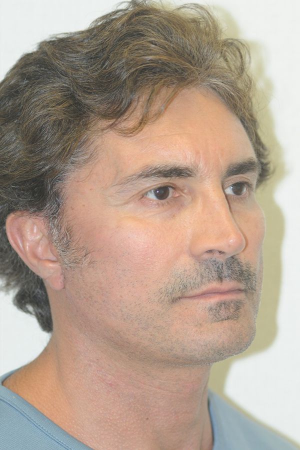 male-facelift-patient-01 After - 2