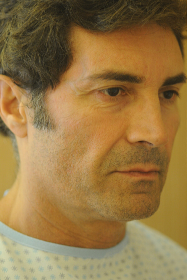 Male Facelift Patient 01 Before - 2