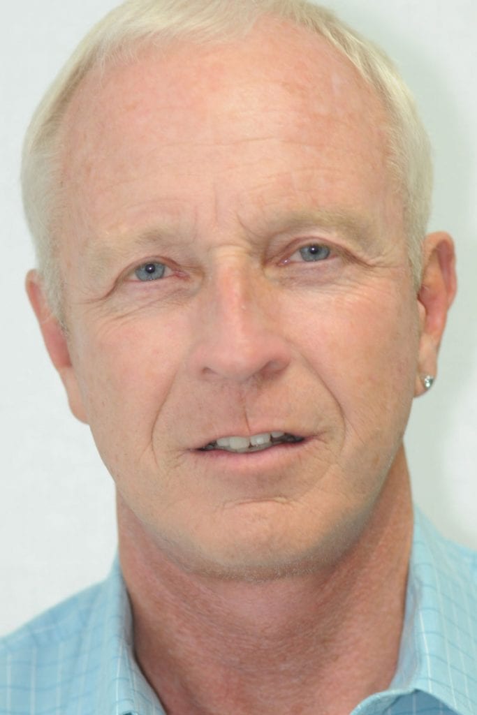male-facelift-patient-03 After