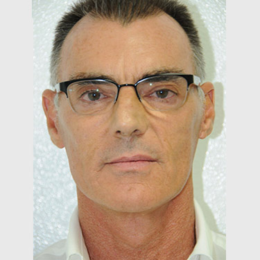 male-facelift-patient-04 After