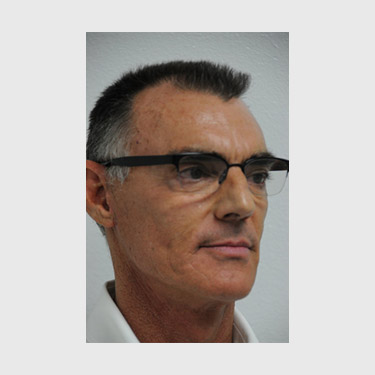 male-facelift-patient-04 After - 2