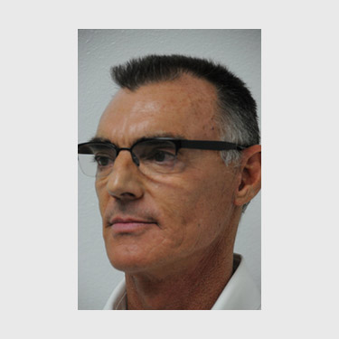 male-facelift-patient-04 After - 3