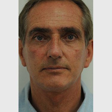 male-facelift-patient-05 After