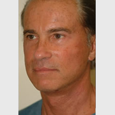 male-facelift-patient-06 After - 2