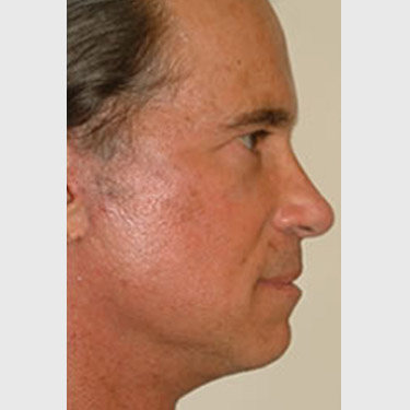male-facelift-patient-06 After - 3