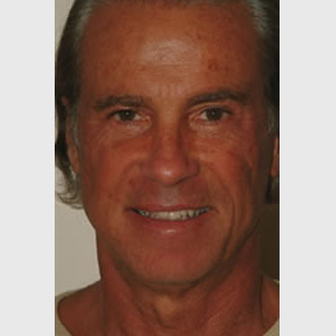 Male Facelift Patient 06 Before