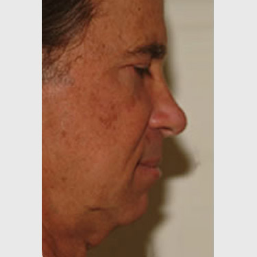 Male Facelift Patient 06 Before - 3
