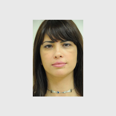 one-stitch-facelift-patient-01 After