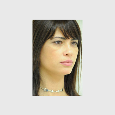one-stitch-facelift-patient-01 After - 2