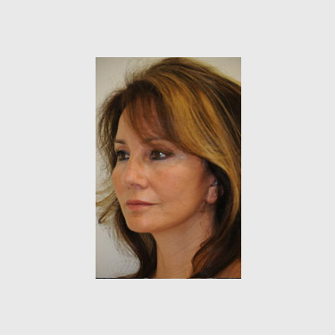 one-stitch-facelift-patient-02 After - 2