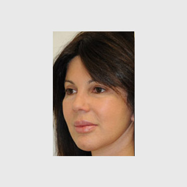 one-stitch-facelift-patient-03 After - 2