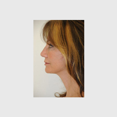 one-stitch-facelift-patient-02 After - 3