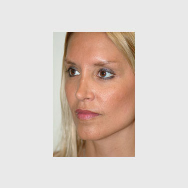 one-stitch-facelift-patient-04 After