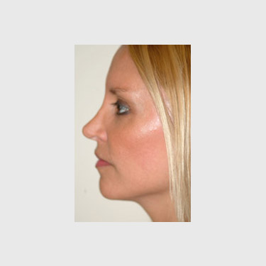 one-stitch-facelift-patient-04 After - 2