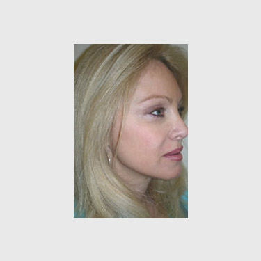 one-stitch-facelift-patient-06 After - 3