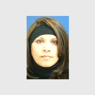 one-stitch-facelift-patient-08 After
