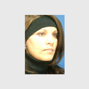 one-stitch-facelift-patient-08 After - 2