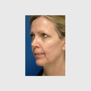 One Stitch Facelift Patient 05 Before - 2