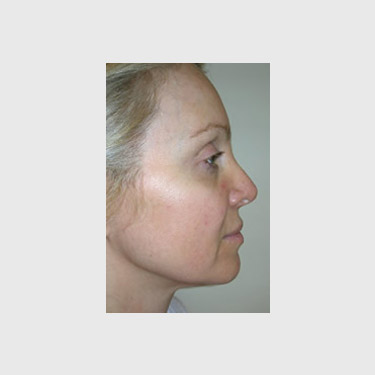 One Stitch Facelift Patient 06 Before - 3