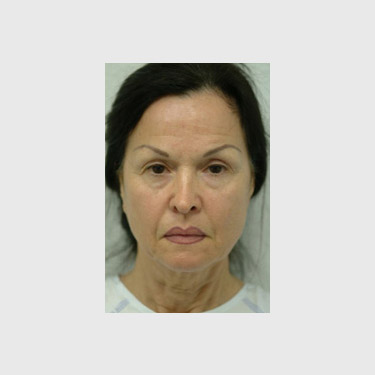 One Stitch Facelift Patient 07 Before