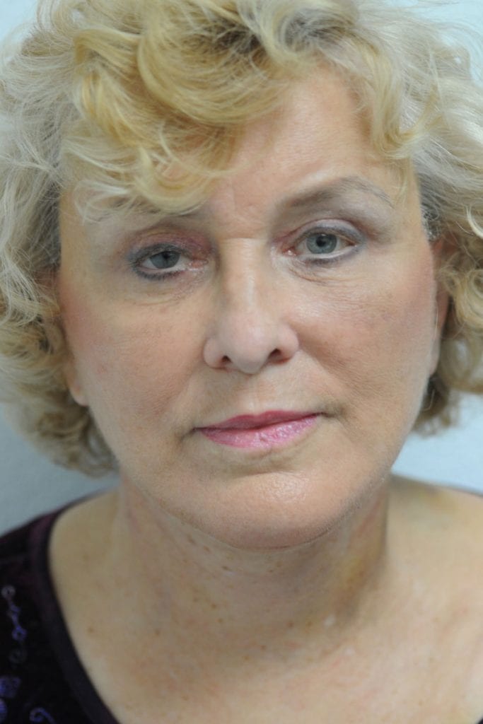 vertical-facelift-patient-14 After