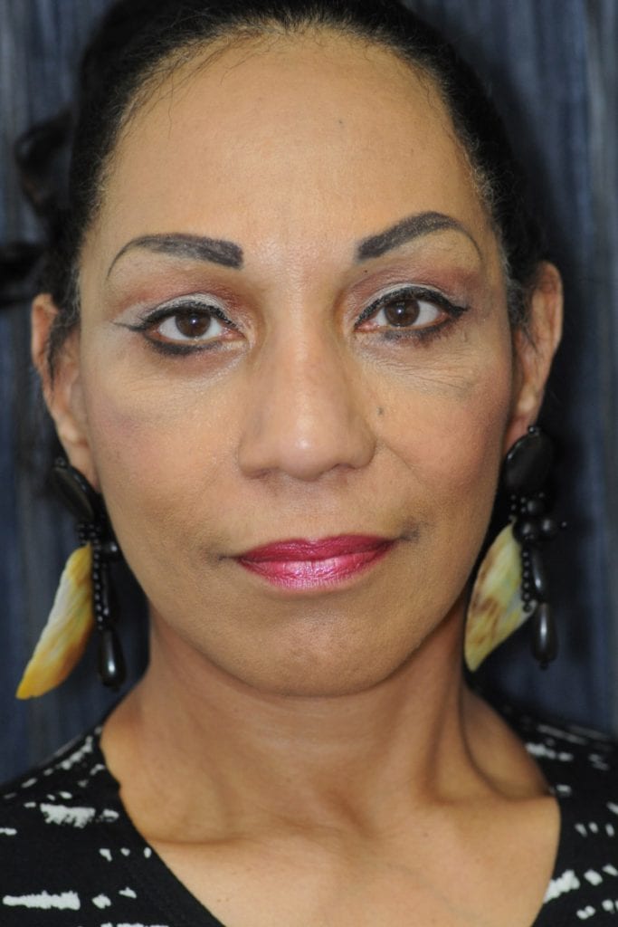 vertical-facelift-patient-06 After