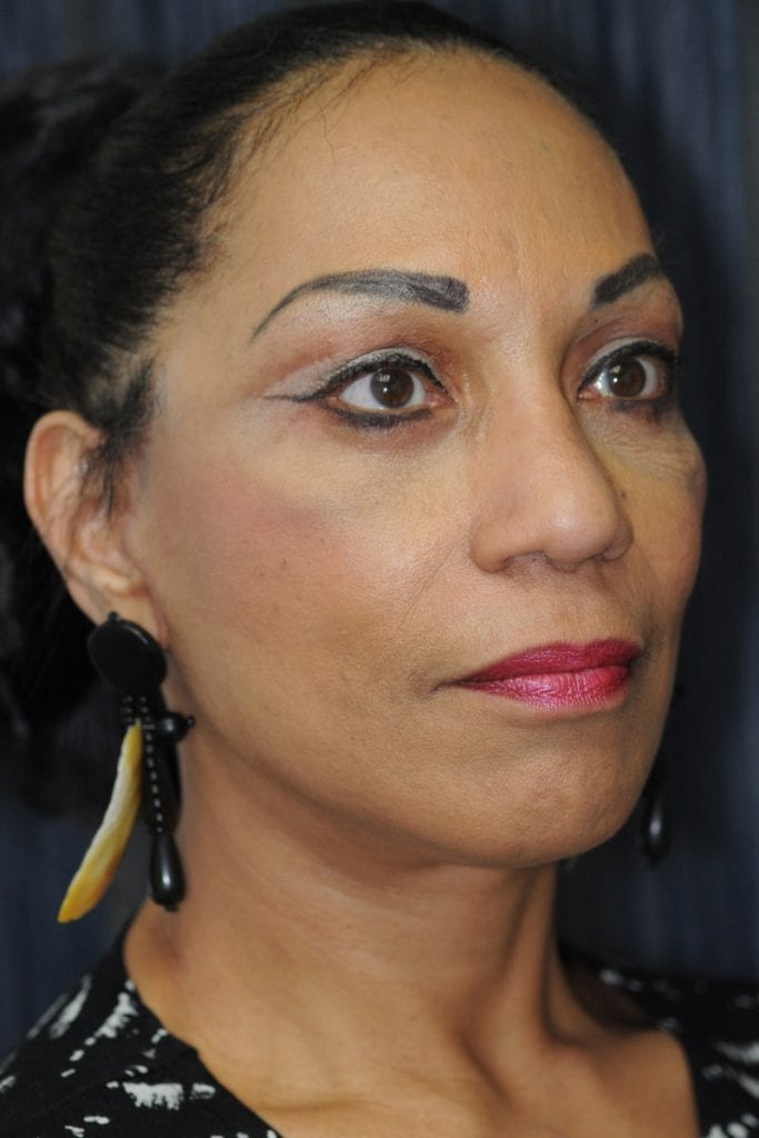 vertical-facelift-patient-06 After - 2