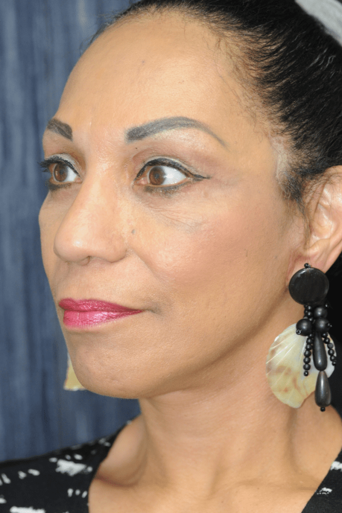 vertical-facelift-patient-06 After - 3