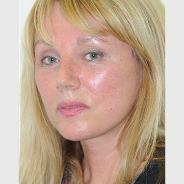 vertical-facelift-patient-10 After