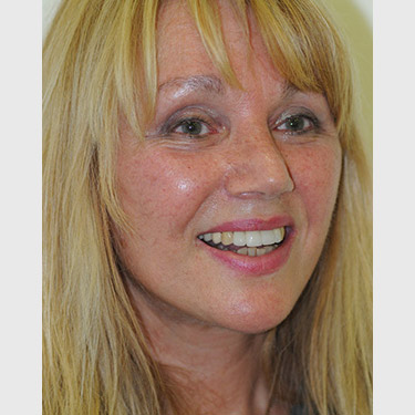 vertical-facelift-patient-10 After - 2