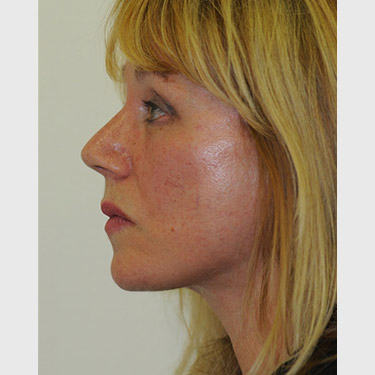 vertical-facelift-patient-10 After - 3