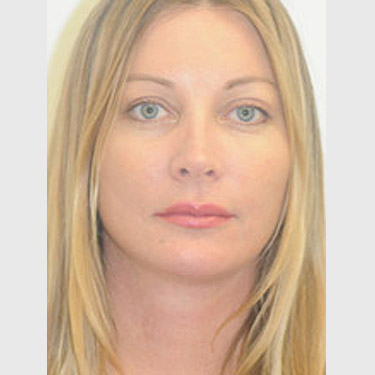 vertical-facelift-patient-12 After