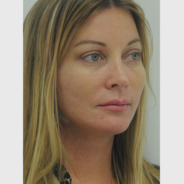 vertical-facelift-patient-12 After - 2
