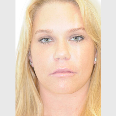 vertical-facelift-patient-04 After