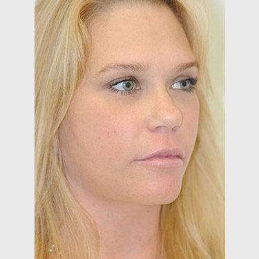 vertical-facelift-patient-04 After - 2
