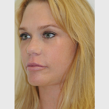 vertical-facelift-patient-04 After - 3