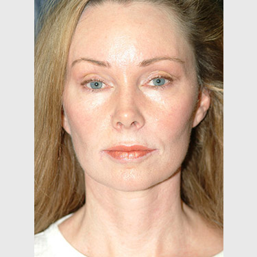 vertical-facelift-patient-05 After