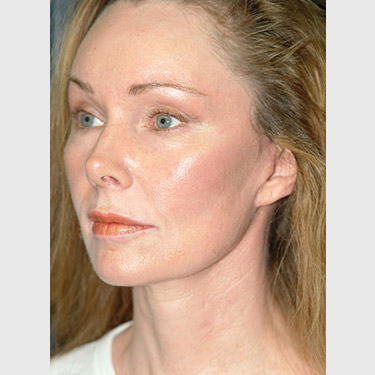 vertical-facelift-patient-05 After - 2