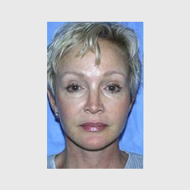 vertical-facelift-patient-08 After