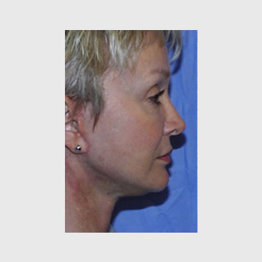 vertical-facelift-patient-08 After - 2