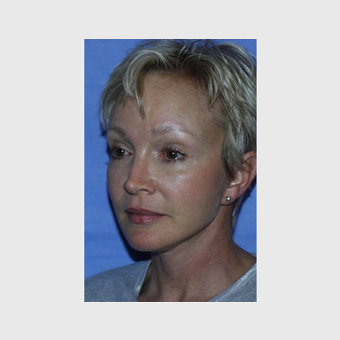 vertical-facelift-patient-08 After - 3