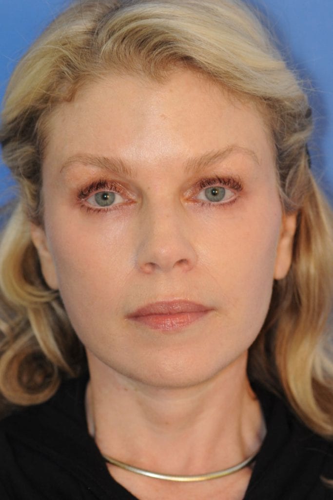 facelift-patient-06 After